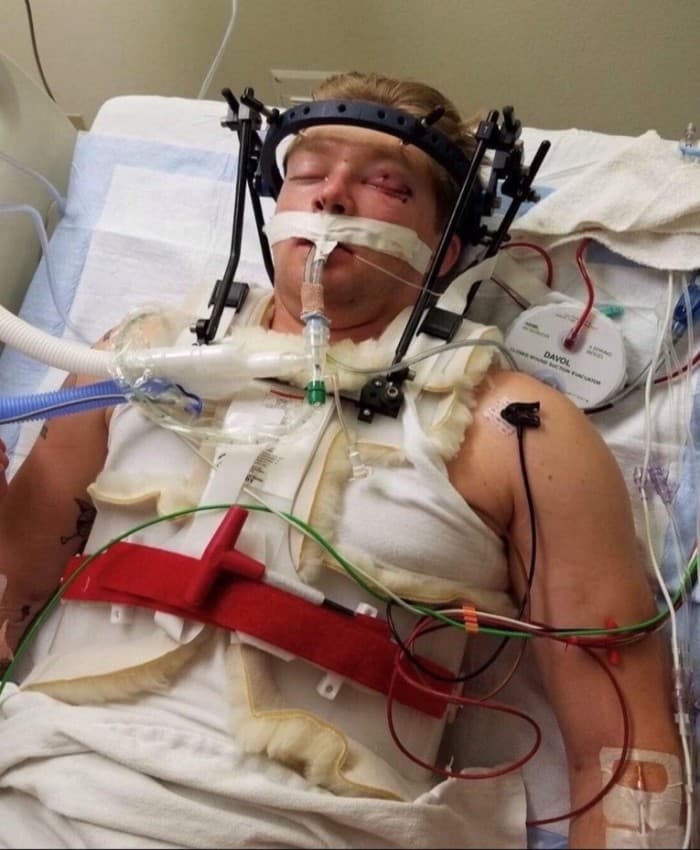 Austin Gibson woke up one month after a high altitude low opening parachute jump accident unable to recall what had happened, and what went wrong before colliding with the ground.